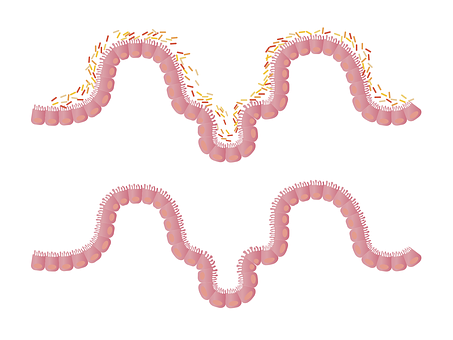 Ways In Which Medical Malpractice Case May Result From Delayed Diagnosis Of Colon Cancer